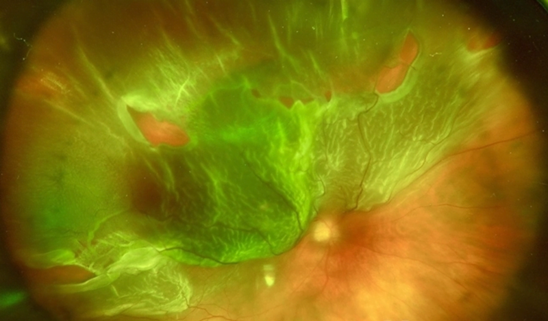 Αποκόλληση αμφιβληστροειδούς