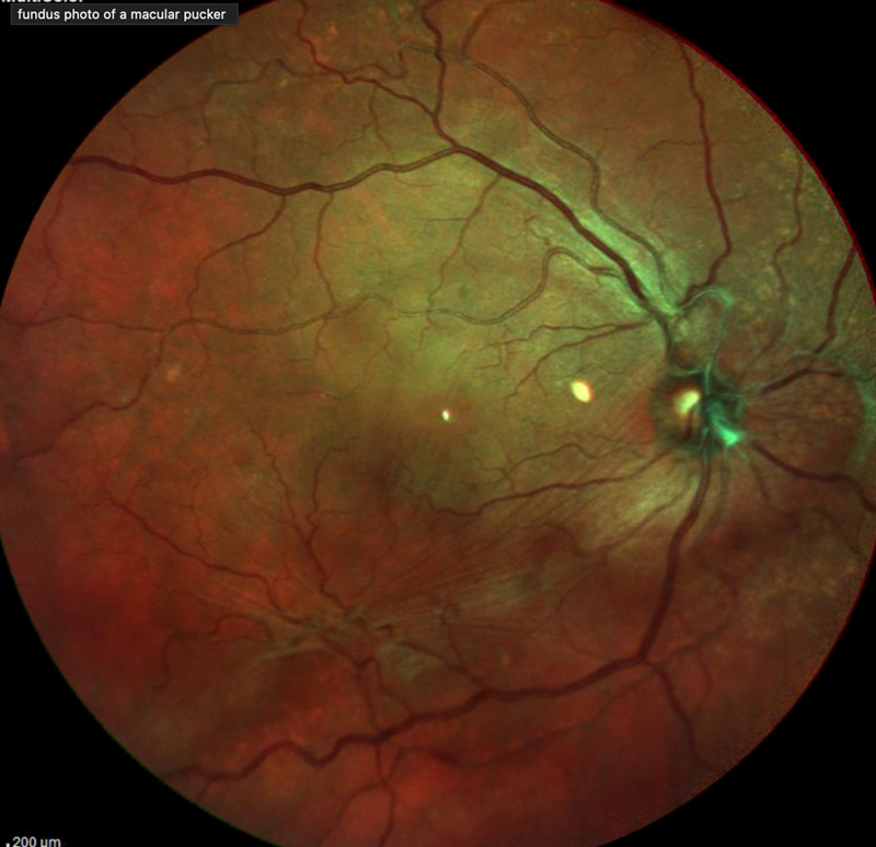 Επιωχρική Μεμβράνη