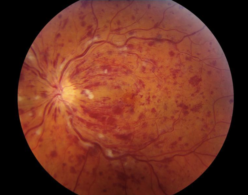 Απόφραξη Φλέβας Αμφιβληστροειδούς