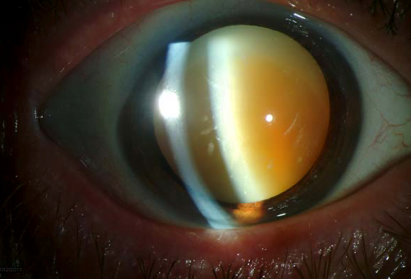 Καταρράκτης